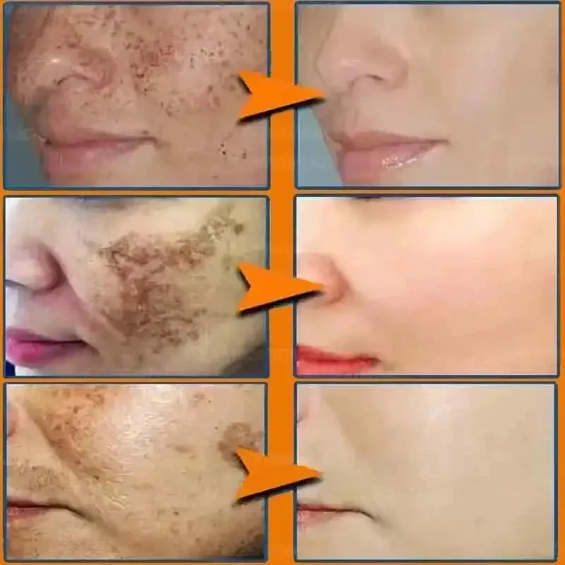 Derma Eterna™ Dark Spot Remover