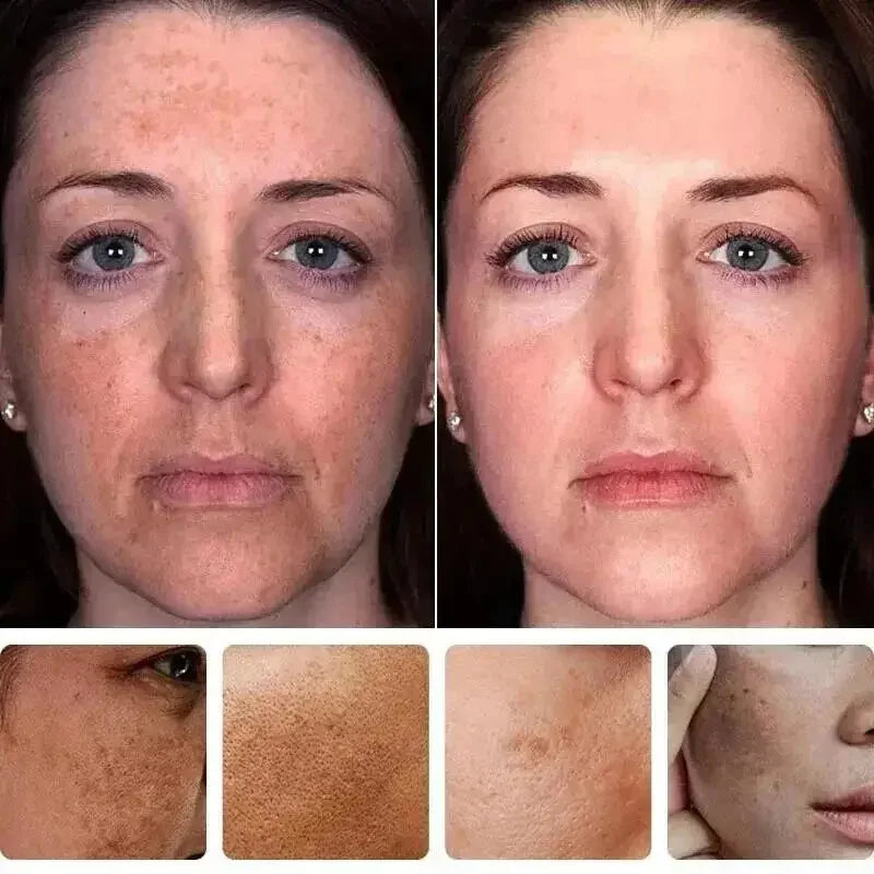 Derma Eterna™ Dark Spot Remover