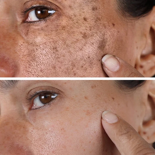 Brighten Up: 7 Surprising Benefits of Using Derma Eterna’s Dark Spot Remover Cream