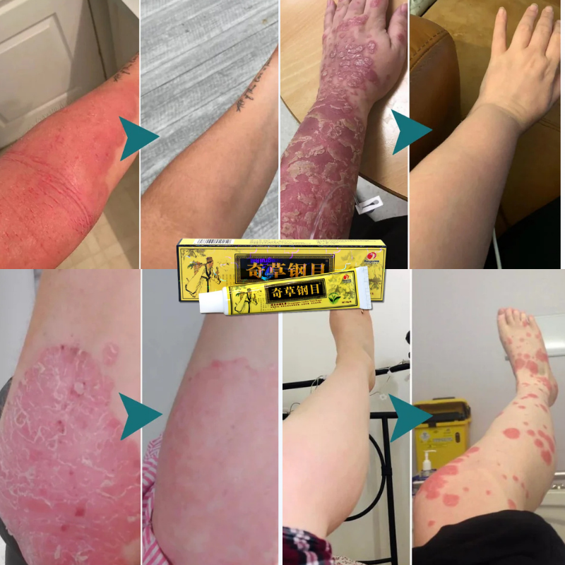 Derma Eterna™ Eczema & Psoriasis Natural Herbal Cream