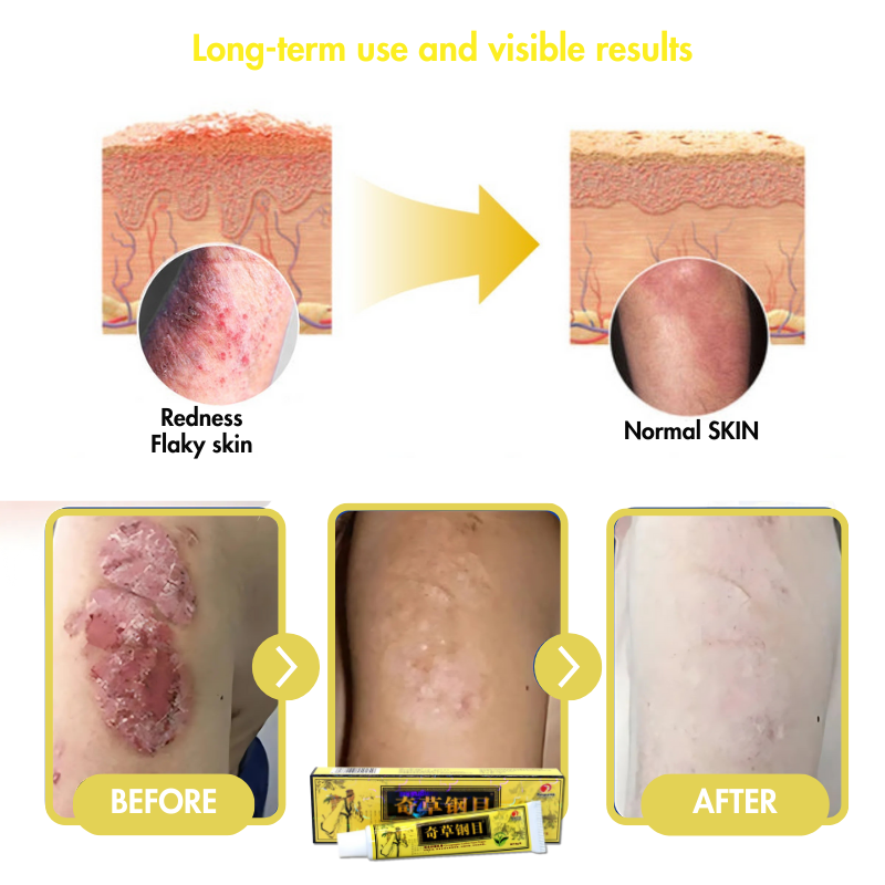 Derma Eterna™ Eczema & Psoriasis Natural Herbal Cream