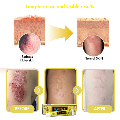 Derma Eterna™ Eczema & Psoriasis Natural Herbal Cream